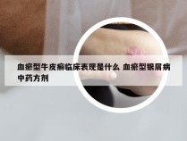 血瘀型牛皮癣临床表现是什么 血瘀型银屑病中药方剂