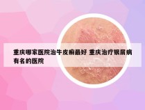 重庆哪家医院治牛皮癣最好 重庆治疗银屑病有名的医院