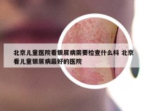 北京儿童医院看银屑病需要检查什么科 北京看儿童银屑病最好的医院