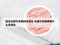 适合头部牛皮癣的洗发水 头部牛皮肤癣用什么洗发水