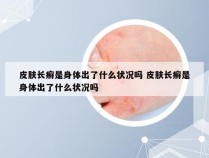 皮肤长癣是身体出了什么状况吗 皮肤长癣是身体出了什么状况吗