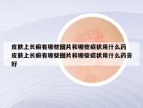 皮肤上长癣有哪些图片和哪些症状用什么药 皮肤上长癣有哪些图片和哪些症状用什么药膏好