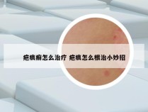 疤痕癣怎么治疗 疤痕怎么根治小妙招