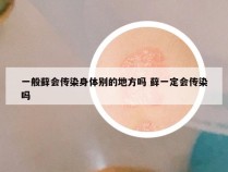 一般藓会传染身体别的地方吗 藓一定会传染吗