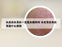 头皮白头发白一定是白癜风吗 头皮发白有白发是什么原因