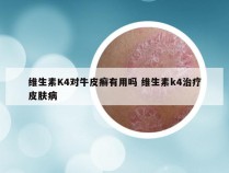 维生素K4对牛皮癣有用吗 维生素k4治疗皮肤病