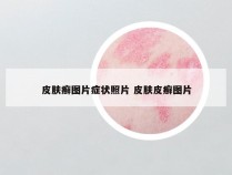 皮肤癣图片症状照片 皮肤皮癣图片