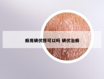 癣用碘伏擦可以吗 碘伏治癣