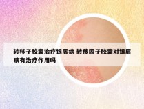 转移子胶囊治疗银屑病 转移因子胶囊对银屑病有治疗作用吗