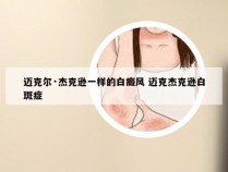 迈克尔·杰克逊一样的白癜风 迈克杰克逊白斑症