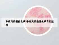 牛皮风癣是什么病 牛皮风癣是什么病毒引起的