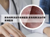 犀角地黄汤治牛皮癣医案 犀角地黄汤治疗银屑病医案