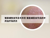 银屑病性关节炎与中药 银屑病型关节炎的中药治疗及药方