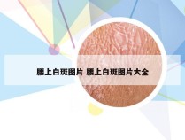 腰上白斑图片 腰上白斑图片大全