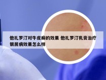 他扎罗汀对牛皮癣的效果 他扎罗汀乳膏治疗银屑病效果怎么样