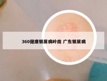 360健康银屑病岭南 广东银屑病