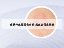 皮肤什么原因会有癣 怎么会得皮肤癣