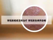 掌拓脓疱症怎样治疗 掌拓脓包病传染嘛