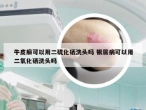 牛皮癣可以用二硫化硒洗头吗 银屑病可以用二氧化硒洗头吗