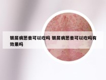 银屑病葱姜可以吃吗 银屑病葱姜可以吃吗有效果吗