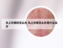 头上长癣的怎么办 头上长癣怎么办用什么治疗