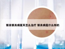 银肖银肖病夏天怎么治疗 银肖病是什么样的