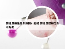 婴儿皮癣是什么原因引起的 婴儿皮肤癣怎么引起的