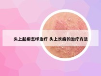 头上起癣怎样治疗 头上长癣的治疗方法