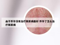 由于怀孕没有治疗银屑病最好 怀孕了怎么治疗银屑病