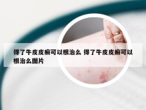 得了牛皮皮癣可以根治么 得了牛皮皮癣可以根治么图片