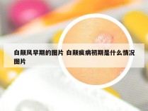 白颠风早期的图片 白颠疯病初期是什么情况图片