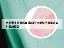 水疱型手癣是怎么引起的 水疱型手癣是怎么引起的原因