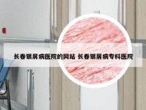 长春银屑病医院的网站 长春银屑病专科医院