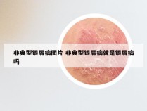 非典型银屑病图片 非典型银屑病就是银屑病吗