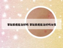 掌趾脓疱能治好吗 掌趾脓疱能治好吗女性