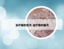 治疗癣的处方 治疗癣的偏方