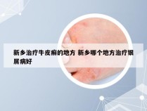 新乡治疗牛皮癣的地方 新乡哪个地方治疗银屑病好