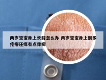 两岁宝宝身上长藓怎么办 两岁宝宝身上很多疙瘩还痒有点像癣