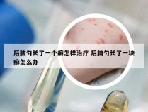 后脑勺长了一个癣怎样治疗 后脑勺长了一块癣怎么办