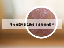 牛皮癣指甲怎么治疗 牛皮肤癣的指甲