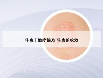 牛皮廯治疗偏方 牛皮的攻效