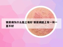 银屑病为什么腿上难好 银屑病腿上有一块一直不好