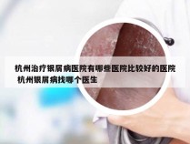 杭州治疗银屑病医院有哪些医院比较好的医院 杭州银屑病找哪个医生