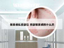 银屑病私密部位 阴部银屑病擦什么药