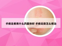 手癣足癣用什么药最快好 手癣足藓怎么根治