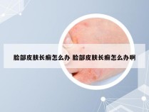 脸部皮肤长癣怎么办 脸部皮肤长癣怎么办啊