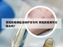 掌跖脓疱病能涂抹炉甘石吗 掌跖脓疱病可以碰水吗?