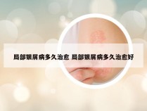 局部银屑病多久治愈 局部银屑病多久治愈好