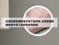 点滴型银屑病把嗓子切了能好吗 点滴型银屑病把嗓子切了能好吗会传染吗