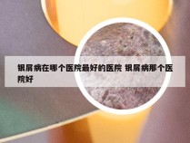 银屑病在哪个医院最好的医院 银屑病那个医院好